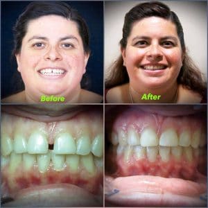 Before and after invisalign.