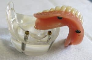 implant retained denture