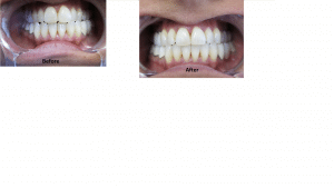 Photo of two mouths, one a 'before' picture and one an 'after' picture.