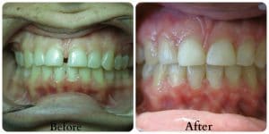 Before photo of yellowed teeth. After photo of whiter teeth and pinkish gums.