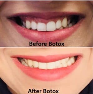Before and after Botox therapy for treating a reverse or upside down smile