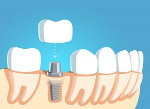 Same-day dental implants in Las Cruces, AZ.