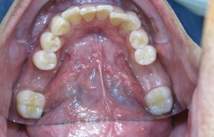 Implant surgery area healed