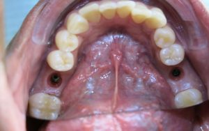 Dental implant surgery