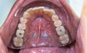 Dental implant restoration