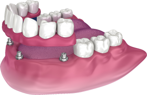 Implant-supported hybrid denture.