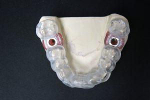 Physical dental implant impression