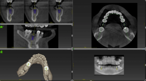 A digital CBCT impression of the mouth for the dental implant procedure.
